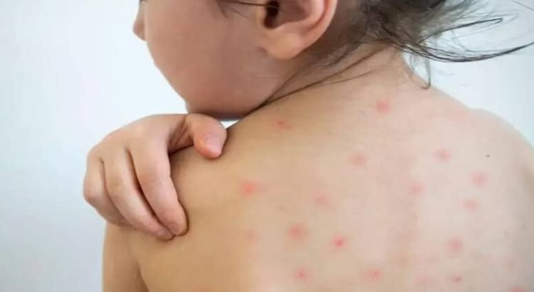 El estado de Coahuila se refuerza contra el sarampión después de 11 casos confirmados