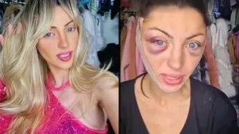 Fallece influencer brasileña apodada la ‘Barbie humana’; investigan las causas de su muerte